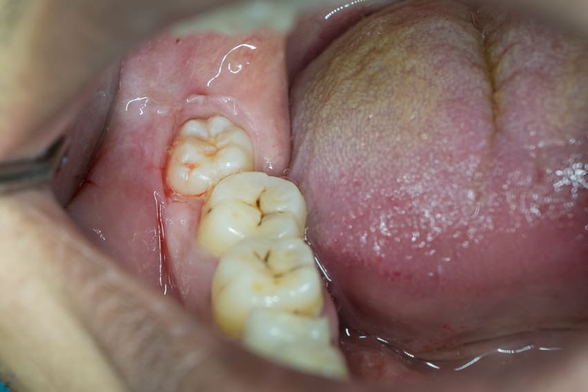 Răng khôn không có tác dụng về chức năng nhai và tính thẩm mỹ.