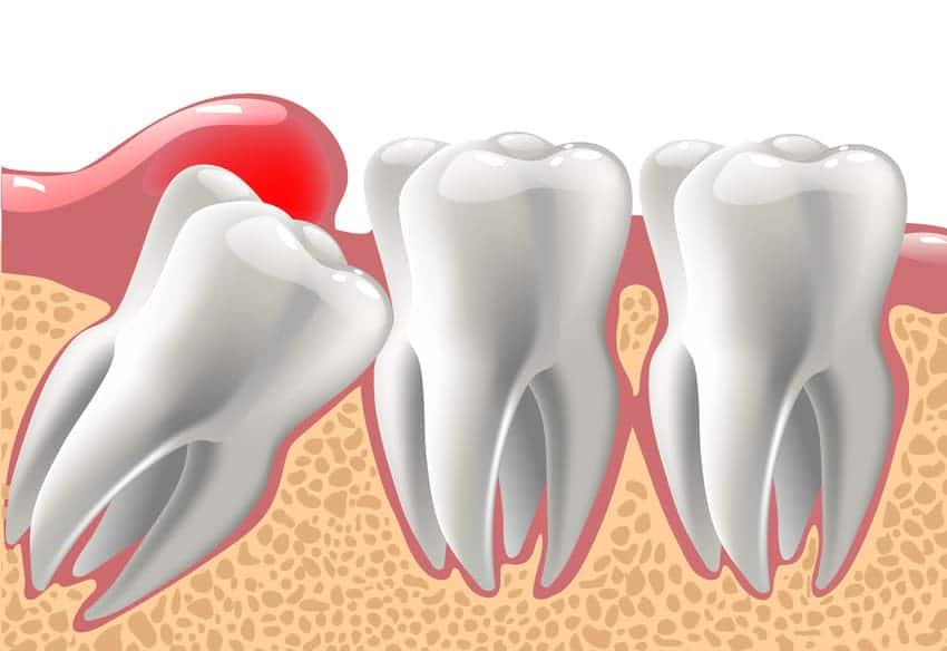 Mọc răng khôn có thể dẫn đến tình trạng viêm nướu, viêm chân răn