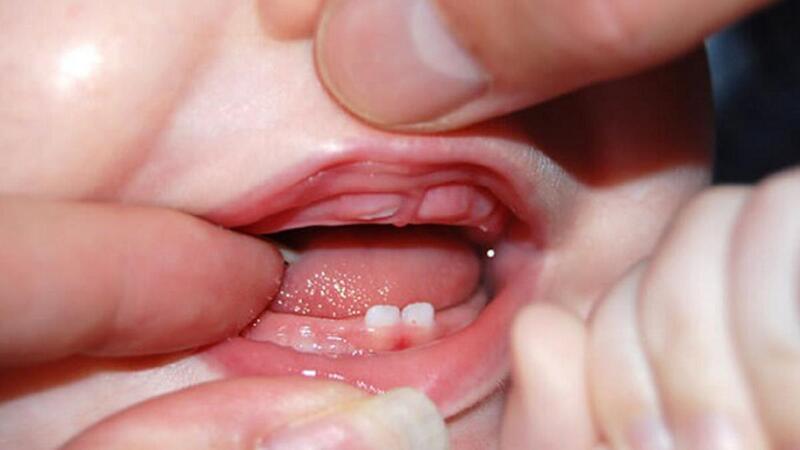Trẻ mấy tháng mọc răng? Thông thưởng trẻ sẽ mọc răng từ 6 đến 8 tháng tuổi