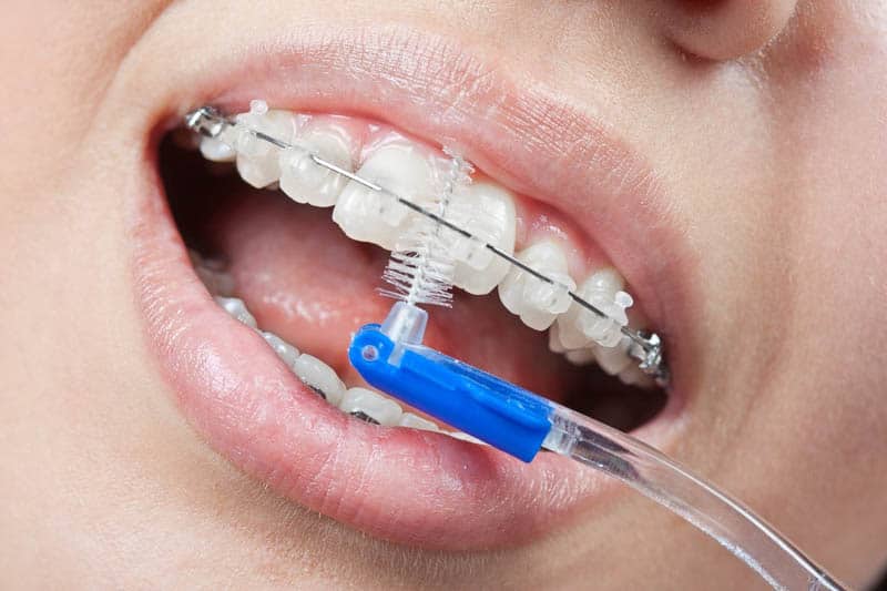 sử dụng bàn chải kẽ răng cho răng niềng