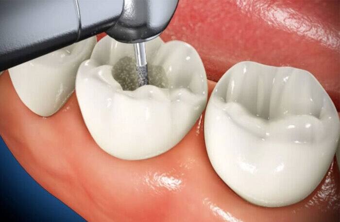 Điều trị lấy tủy răng