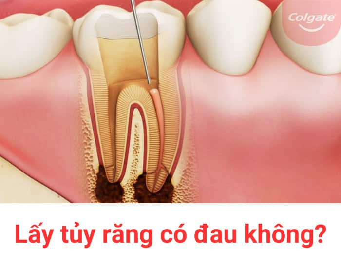 Lấy tủy răng có đau không?