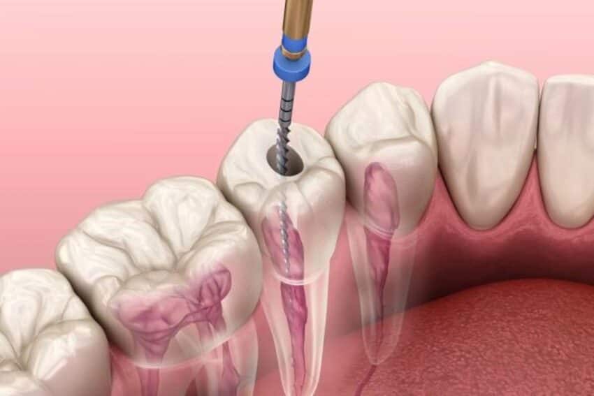 Lấy tủy răng là phương pháp cần thiết để điều trị sâu răng tuỷ..