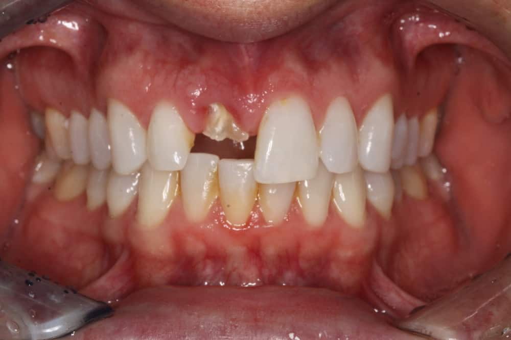 mẻ răng là một phần trong cấu trúc răng bị mất