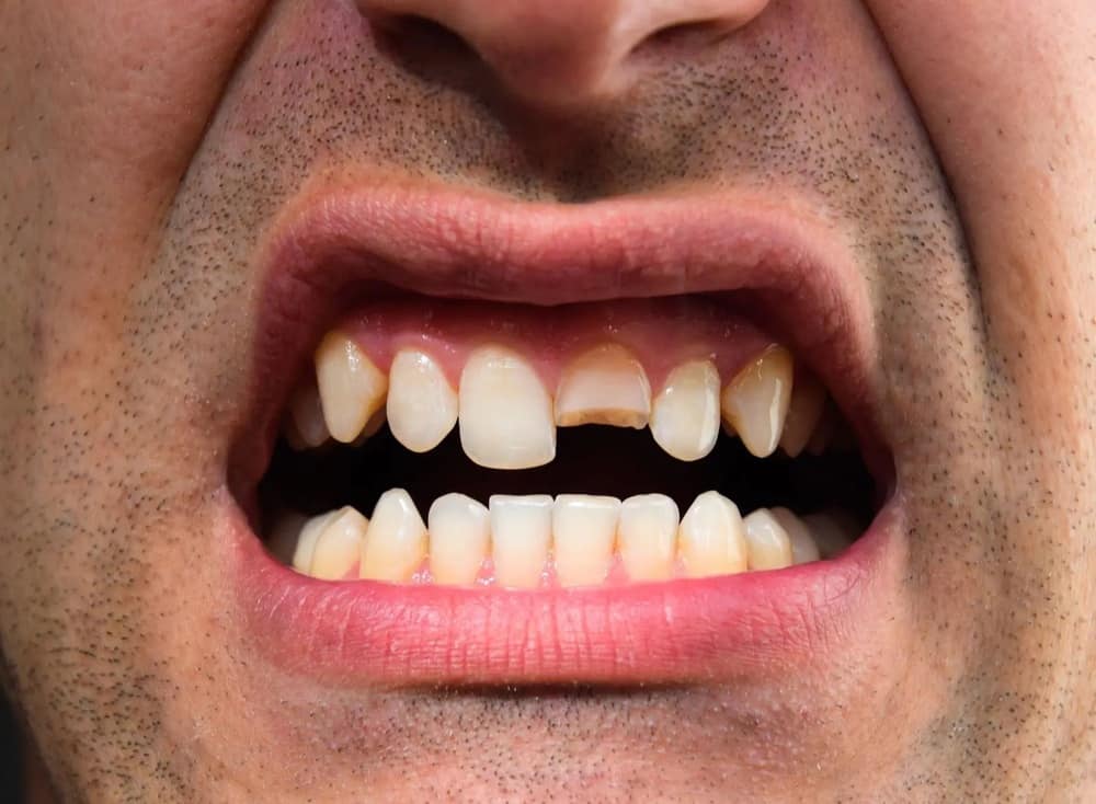 Răng bị mẻ gây ảnh hưởng đến sức khỏe