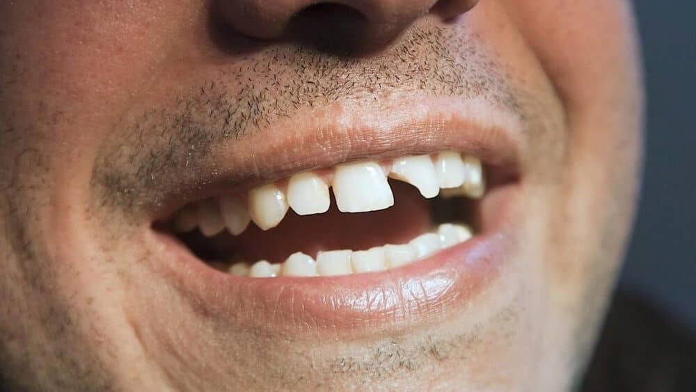 Răng bị mẻ có trám được không?