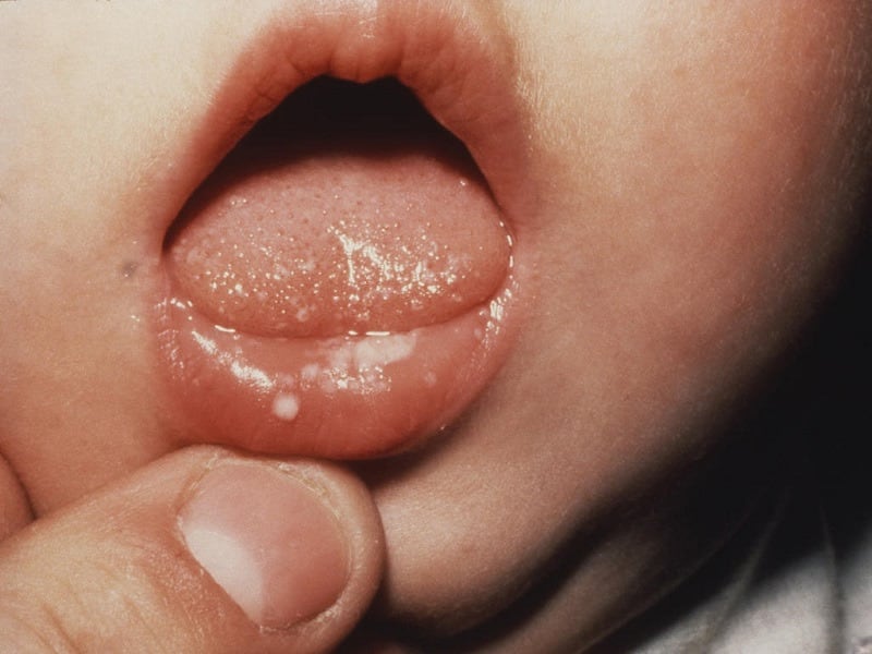 Trẻ em có nguy cơ bị nấm miệng cao