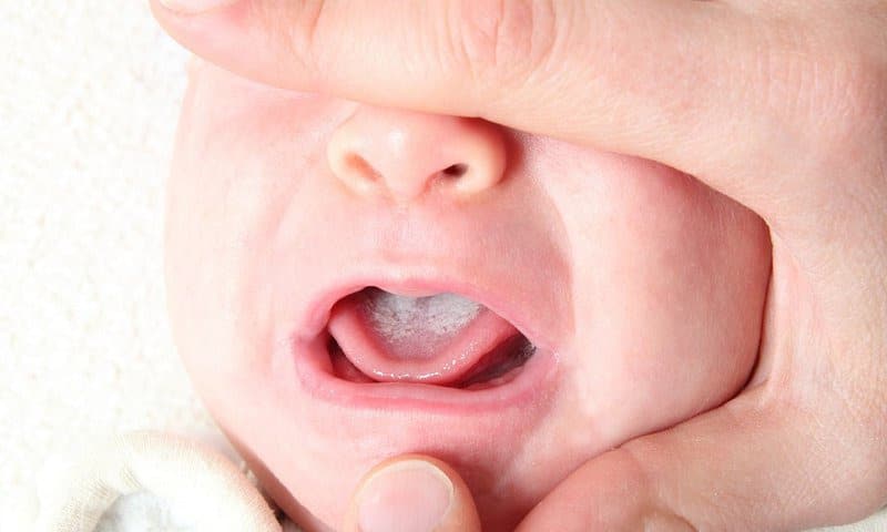 Trẻ bị nấm bao lâu thì khỏi