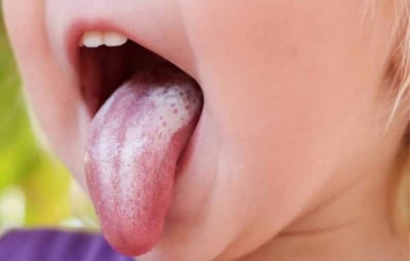 Thuốc trị nấm miệng ở trẻ 