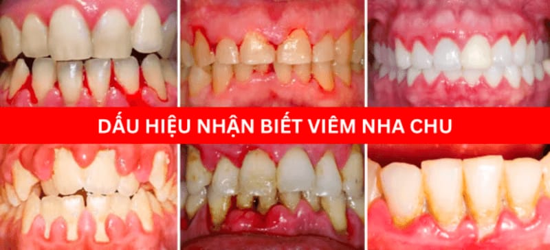 Dấu hiệu viêm nha chu là nướu sưng đỏ, xuất hiện túi mủ