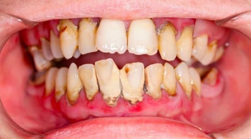 Nguyên nhân gây viêm nha chu là vi khuẩn từ mảng bám trên răng