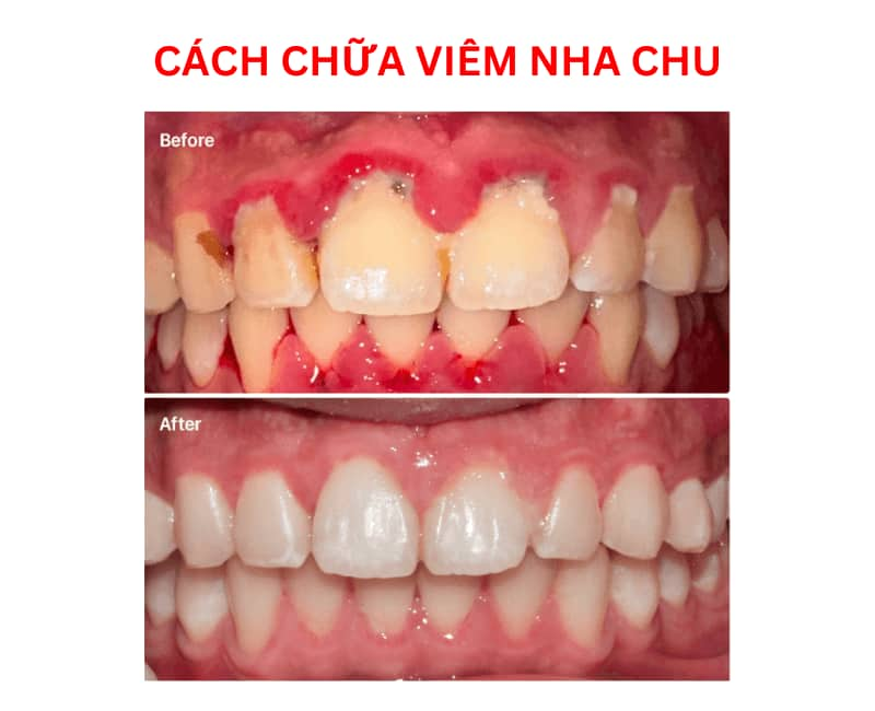 Cách chữa trị bệnh viêm nha chu