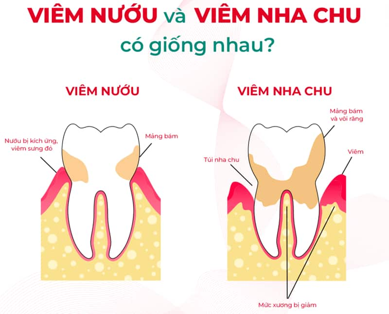 Phân biệt viêm nha chu và viêm nướu