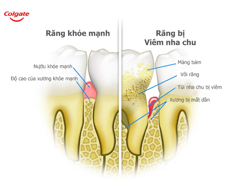 Viêm nha chu là tình trạng tổ chức quanh răng bị viêm nhiễm