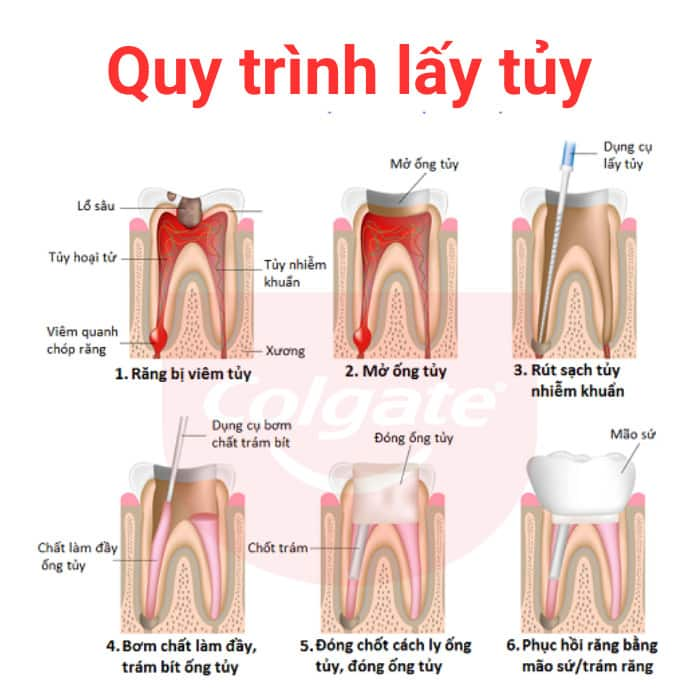 Quy trình lấy tủy