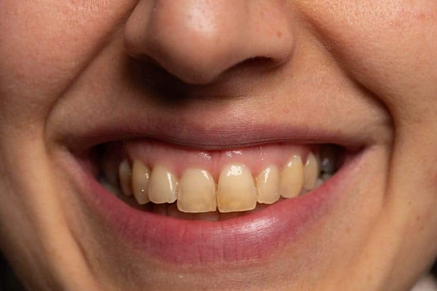Răng bị ố vàng do sử dụng thực phẩm dễ bám màu lên răng.
