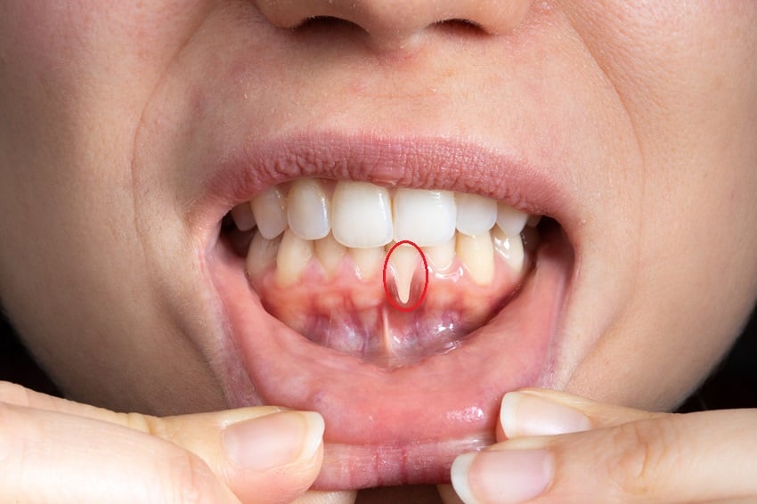 Tụt lợi khiến chân răng lộ ra ngoài