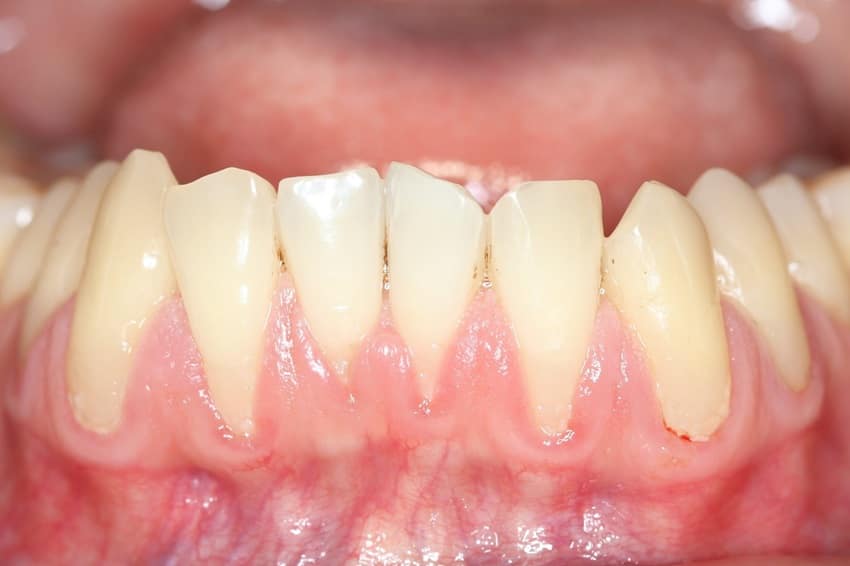 Tụt lợi do lực tác động