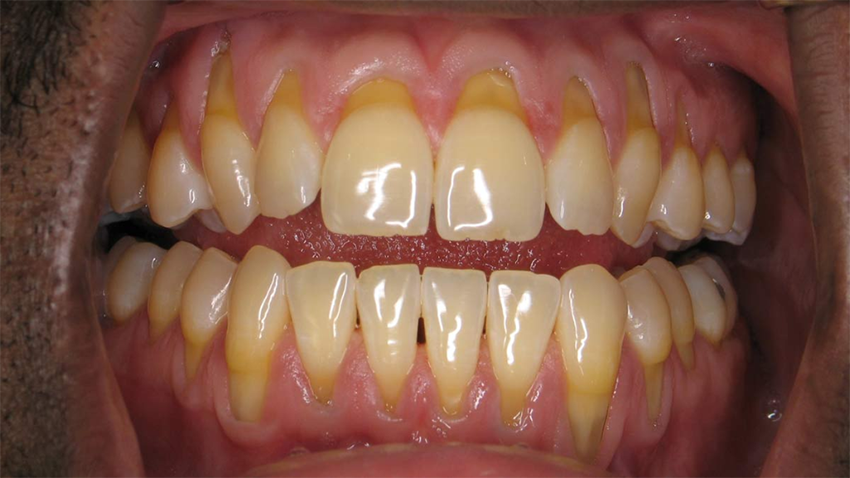 Tụt lợi: Phương pháp điều trị, ngăn ngừa tụt lợi hiệu quả