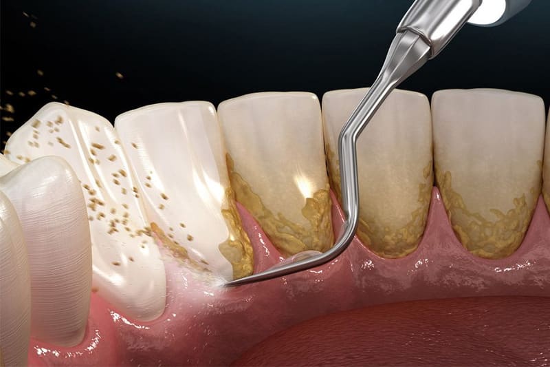 Loại bỏ cao răng càng sớm càng tốt ngay khi phát hiện