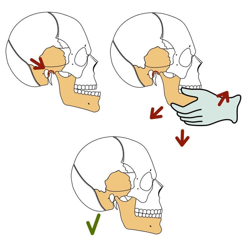 TMJ xảy ra khi khớp thái dương hàm, hoạt động giống như một "bản lề trượt", kết nối hàm trên và hàm dưới của bạn, gặp vấn đề dẫn đến đau nhức và lệch khớp.