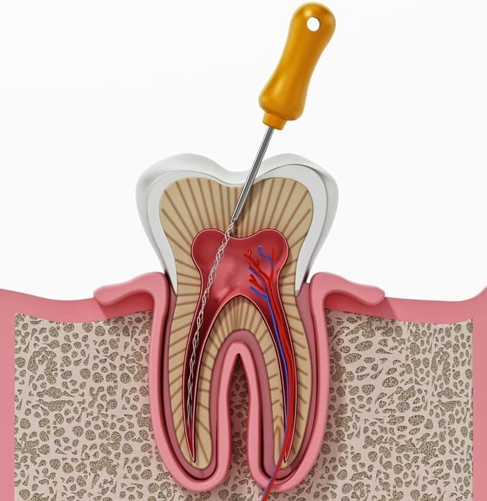 Lấy tủy răng là quá trình loại bỏ mô tủy viêm nhiễm, hoại tử