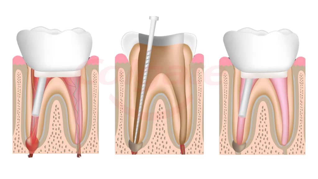 how-many-teeth-do-humans-have - root-canals