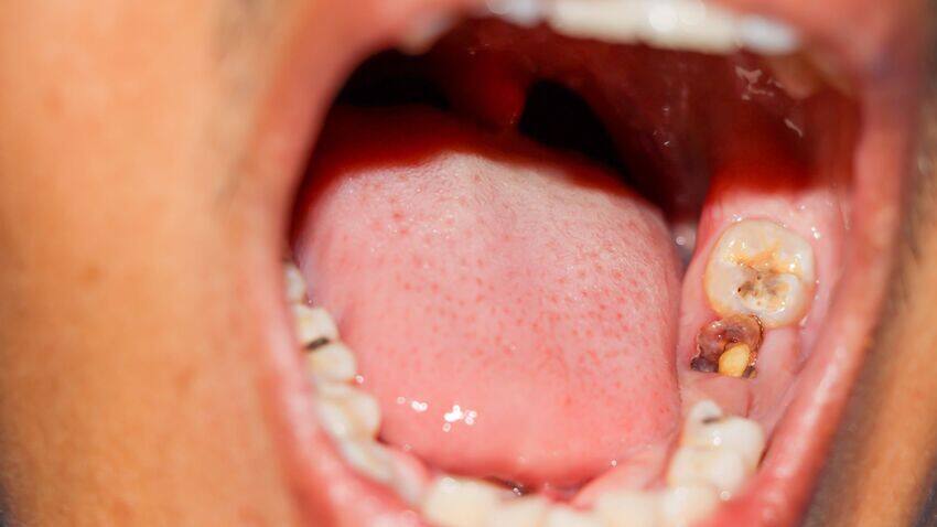 Sâu răng hàm và viêm tủy
