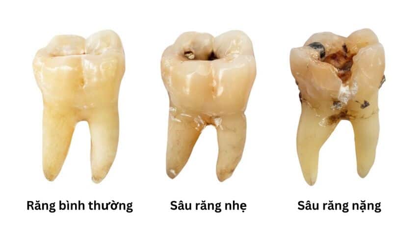 Sâu răng là tình trạng men răng bị tấn công