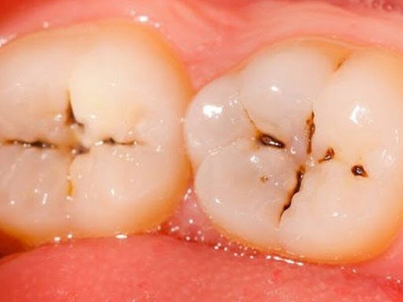 5 cách đặc biệt làm trắng răng tự nhiên