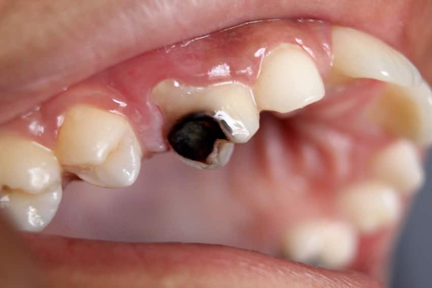 Răng bị sâu xuất hiện các đốm đen
