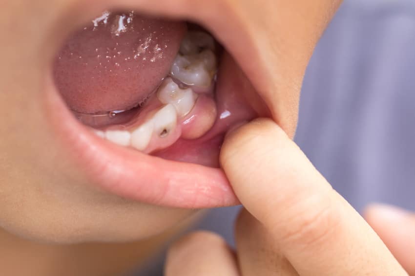 Các dấu hiệu nhận biết sưng nướu răng: nướu tấy đỏ và sưng phù