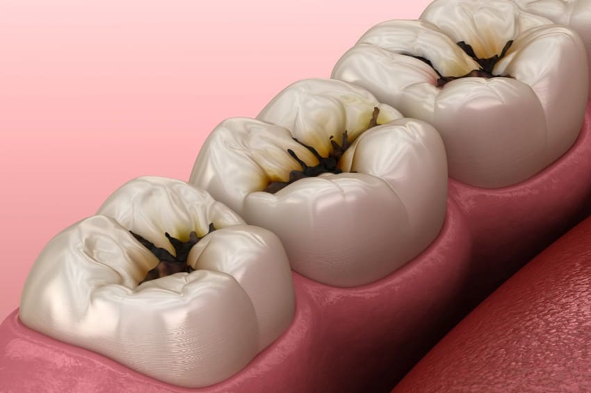 Viêm tủy răng gây sưng đau chân răng