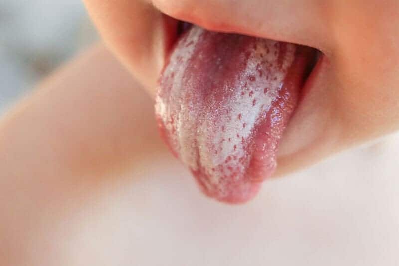 Bệnh tưa miệng (tên gọi khác là tưa lưỡi, nấm lưỡi) là tên gọi phổ biến của bệnh nhiễm trùng miệng do sự phát triển quá mức của nấm Candida
