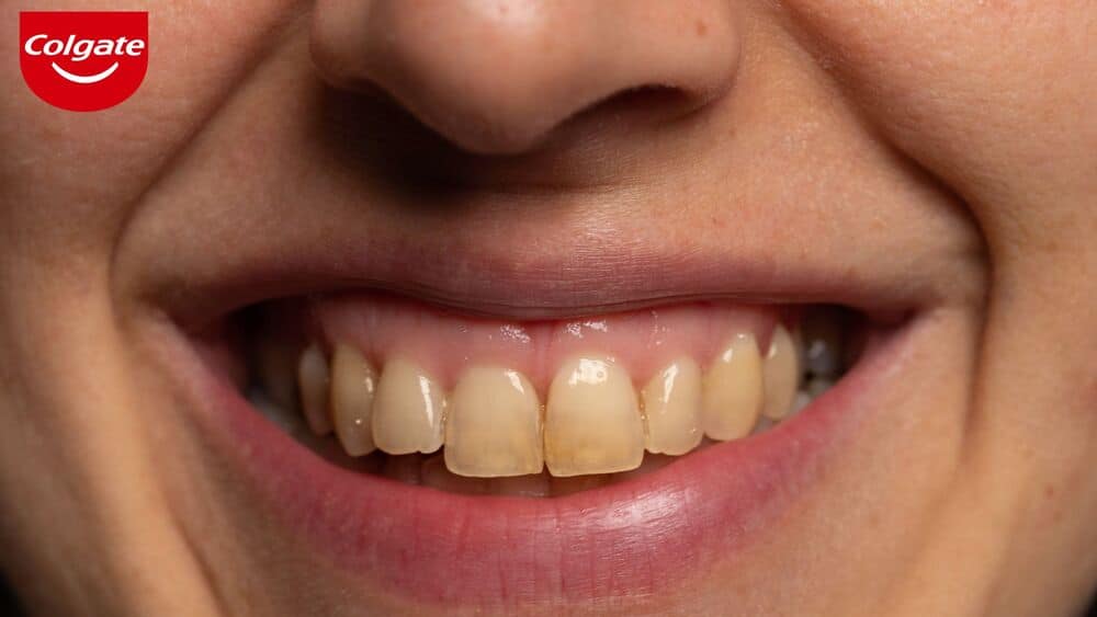 Tình trạng răng bị ố vàng là gì?