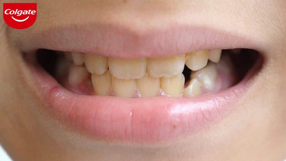 Răng bị ố vàng do sử dụng thực phẩm sẫm màu 