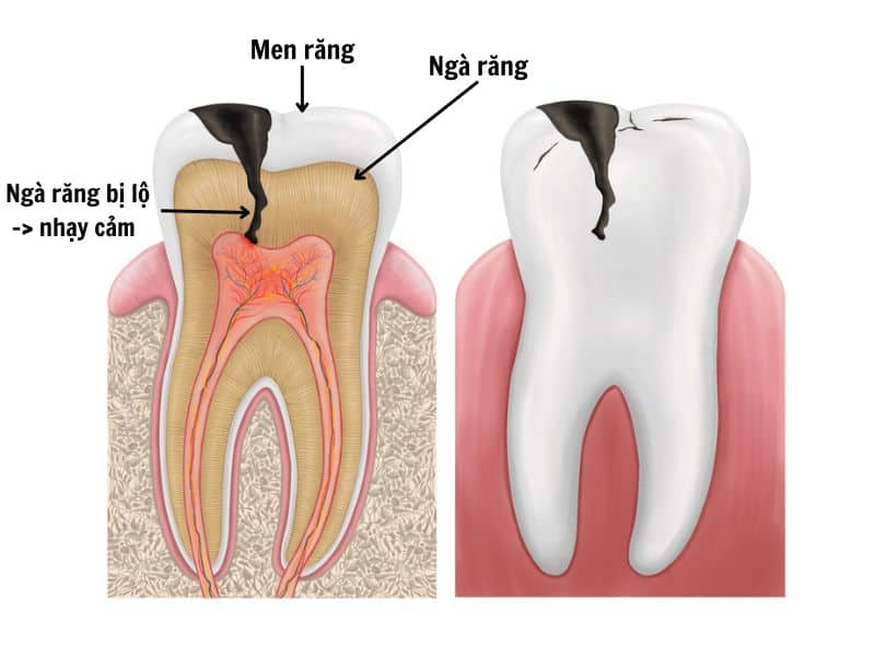 Men răng hỏng làm lộ ngà răng gây ê buốt, khó chịu