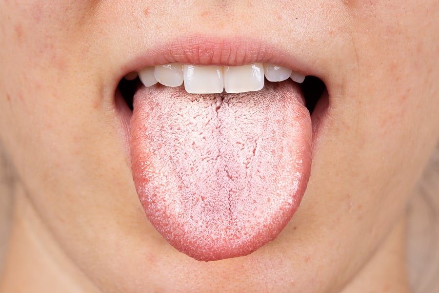 Dấu hiệu lưỡi trắng là bệnh gì