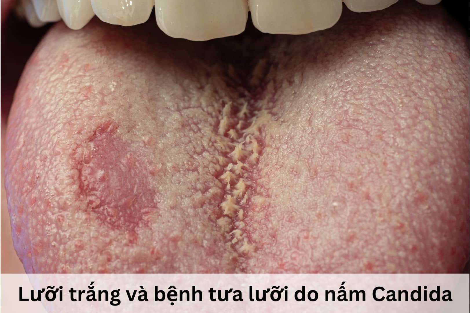 Dấu hiệu lưỡi trắng và nhiễm nấm Candida