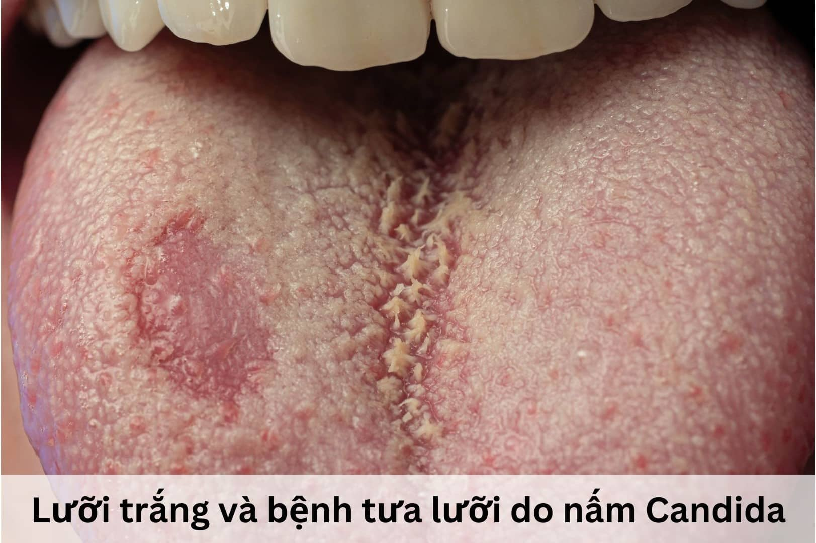 Tại sao lưỡi là nơi thường xuất hiện dấu hiệu của HIV?