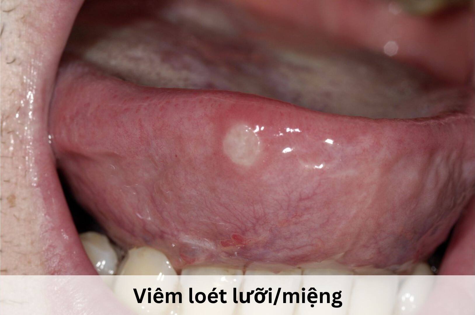  Viêm loét lưỡi/miệng gây trắng lưỡi