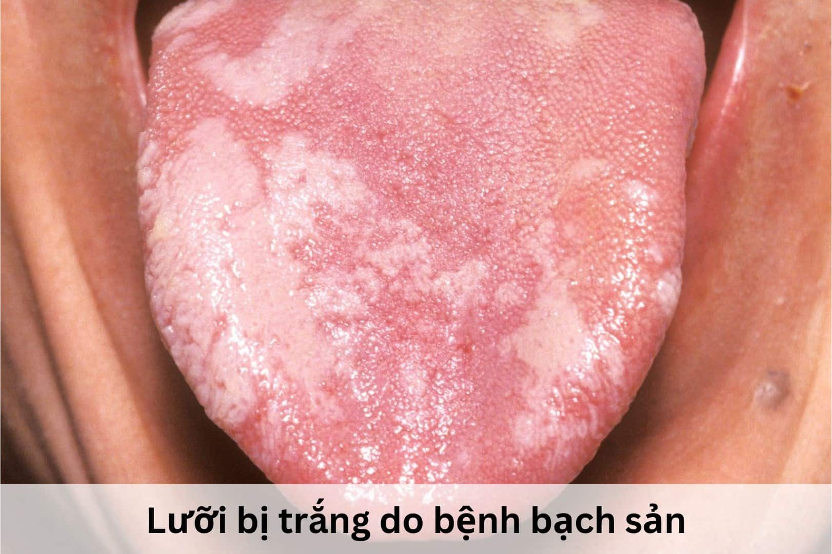 Lưỡi bị trắng do bệnh bạch sản