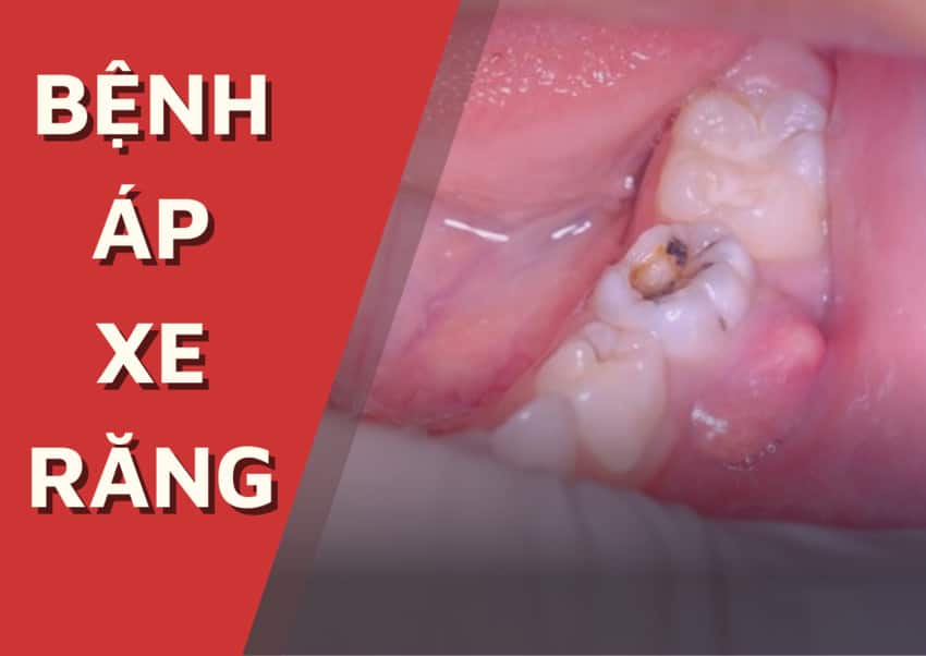 Bệnh áp xe răng là răng hình thành ổ viêm nhiễm sưng thành một khối u mềm do tích tụ vi khuẩn.