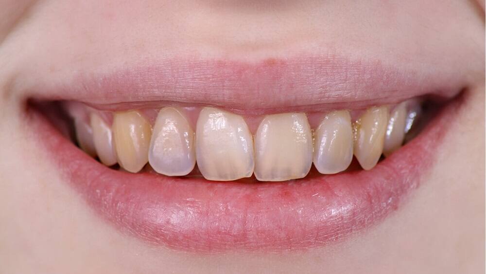 mòn răng khiến màu răng bị thay đổi