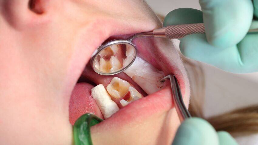Làm sạch răng sâu và trám răng là phương pháp điều trị phổ biến