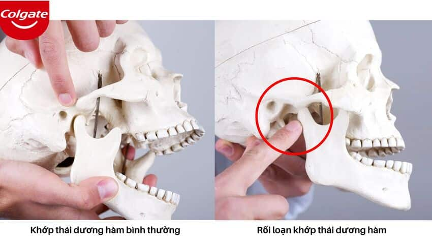 Rối loạn khớp thái dương hàm (Rối loạn TMJ) là gì?