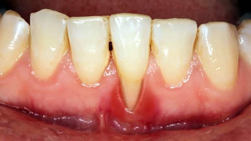 Biến chứng của tụt nướu răng tác động đến sức khỏe