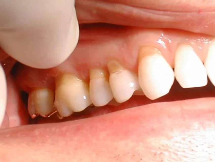 Dấu hiệu tụt lợi chân răng