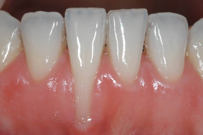 Tụt nướu răng là tình trạng mất mô nướu quanh răng