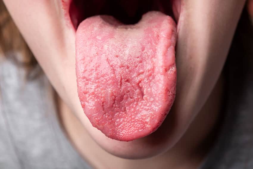 Viêm lưỡi khiến các nhú lưỡi biến mất gây ảnh hưởng đến vị giác.